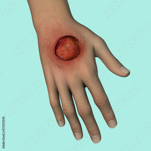 Buruli ulcer on an arm, 3D illustration. The disease caused by Mycobacterium ulcerans bacteria photo