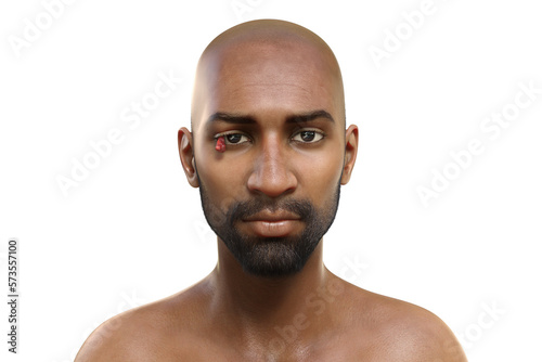 Ocular rhinosporidiosis in a patient, 3D illustration. A disease caused by Rhinosporidium seeberi parasite photo