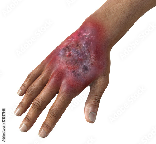 Protothecosis infection on human hand, 3D illustration photo