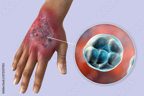 Protothecosis infection on human hand and close-up view of Prototheca wickerhamii green algae, 3D illustration photo