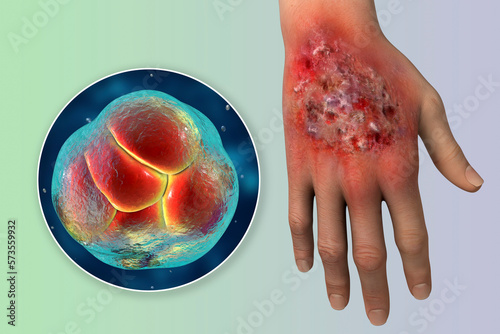 Protothecosis infection on human hand and close-up view of Prototheca wickerhamii green algae, 3D illustration photo