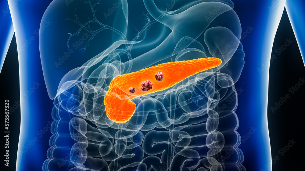 Pancreas or pancreatic cancer with organs and tumors or cancerous cells 3D rendering illustration with male body. Anatomy, oncology, disease, medical, biology, science, healthcare concepts. - obrazy, fototapety, plakaty 