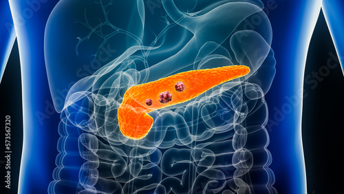 Pancreas or pancreatic cancer with organs and tumors or cancerous cells 3D rendering illustration with male body. Anatomy, oncology, disease, medical, biology, science, healthcare concepts.