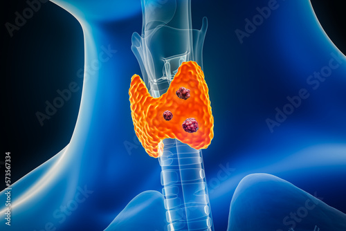 Thyroid cancer with organs and tumors or cancerous cells 3D rendering illustration with male body contours. Anatomy, oncology, biomedical, medical, biology, science, healthcare concepts. photo