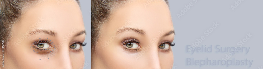Lower and upper Blepharoplasty.Marking the face.Perforation lines on females face, plastic surgery concept. Lower and upper Blepharoplasty.Marking the face.Perforation lines on females face, plastic surgery concept.