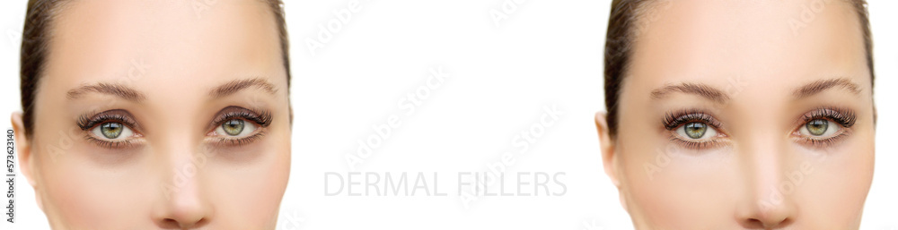 Tear Trough Filler,A-frame deformity. Fat grafting or dermal filler treatments .Hyaluronic acid injections for specific areas. Tear Trough Filler,A-frame deformity. Fat grafting or dermal filler treatments .Hyaluronic acid injections for specific areas.