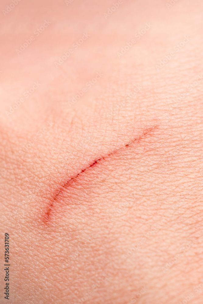 Close-up scratch on the skin Close-up scratch on the skin