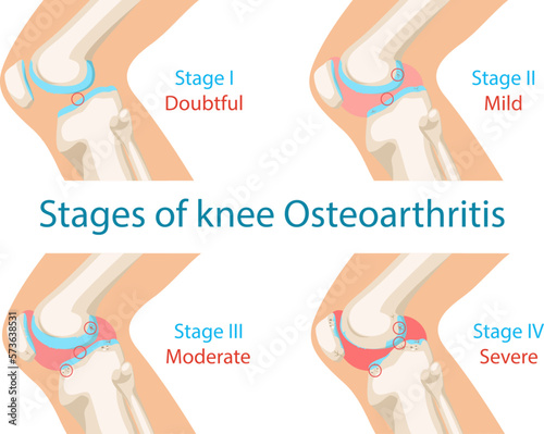 Stages of osteoarthritis of the knee. Main stages of knee osteoarthritis. Vector infographic poster Anatomy of knee joint. Medical concept infographic.