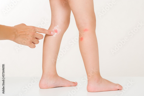 Young adult mother finger applying white moisturizing cream on toddler leg on light gray background. Red rash after bite of mosquito or food allergy. Care about child body skin. Closeup. Side view.