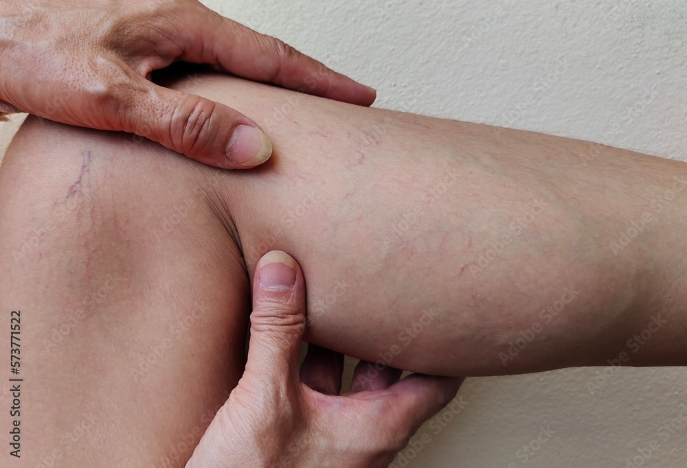 portrait showing the hand holding the varicose spider veins on the leg, swelling of the calves woman's, problem wrinkles and circulation of blood, health care and beauty concept. portrait showing the hand holding the varicose spider veins on the leg, swelling of the calves woman's, problem wrinkles and circulation of blood, health care and beauty concept.