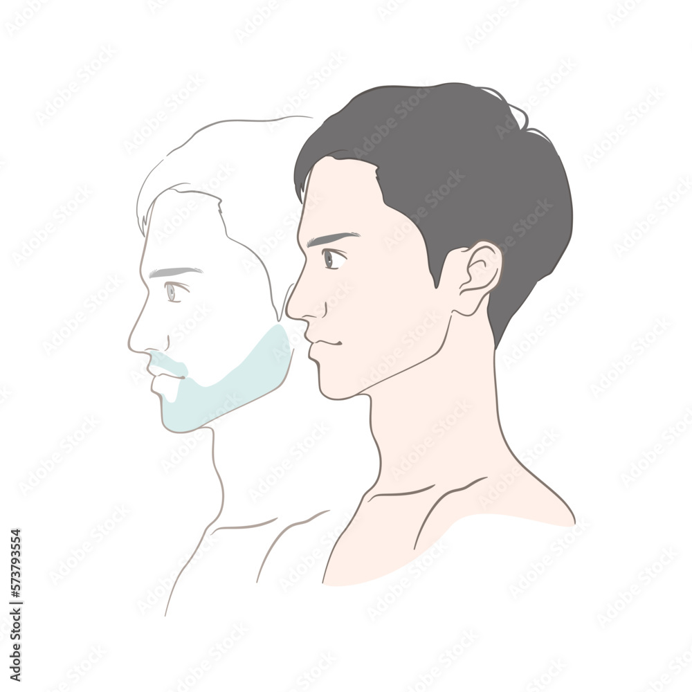 若い青髭の男性の髭脱毛ビフォーアフターイメージイラスト（横顔）