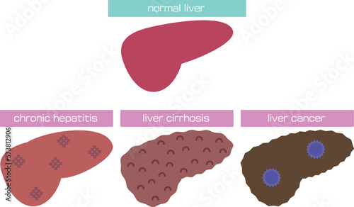 慢性肝炎から肝癌までを表したイラスト／Illustration showing from chronic hepatitis to liver cancer