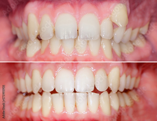 Complete smile makeover from crooked teeth to well aligned smile. Before/after after using aligners invisalign or brackets