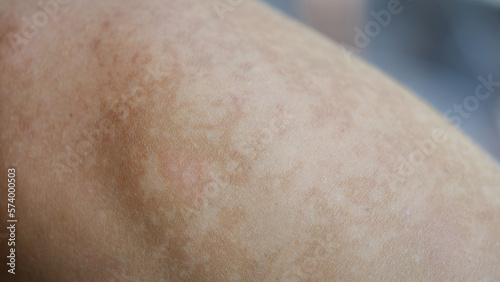 Bilde på lerret Macro part of the body is uneven pigmentation skin