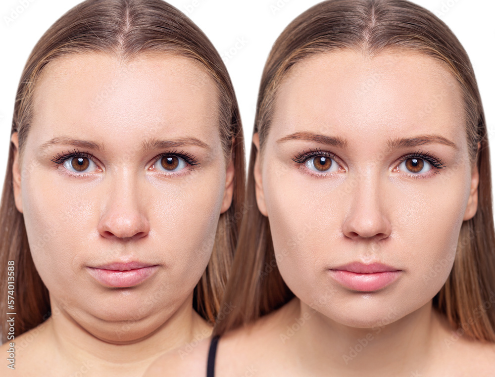Woman before and after chin correction. Plastic surgery concept.
