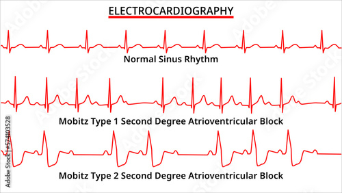 Set of ECG Common Abnormalities - Normal Sinus Rhythm - Mobitz Type 1 and 2 - Second Degree Atrioventricular (AV) Block - Electrocardiography - Vector Medical Illustration