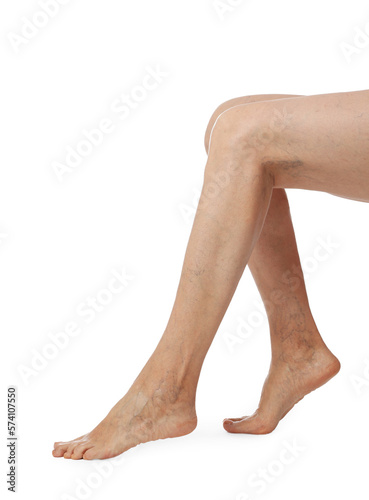 Closeup view of woman with varicose veins on white background