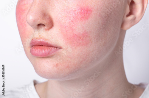 rosacea couperose redness skin, red spots on cheeks, young woman with sensitive skin, patient face close-up  photo