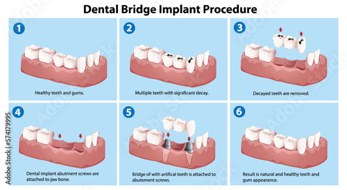 Dental bridge implant procedure