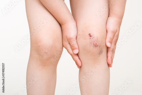 Toddler girl hands touching and showing abrasion knee skin isolated on light gray background. Child after fell down. Closeup. Front view.