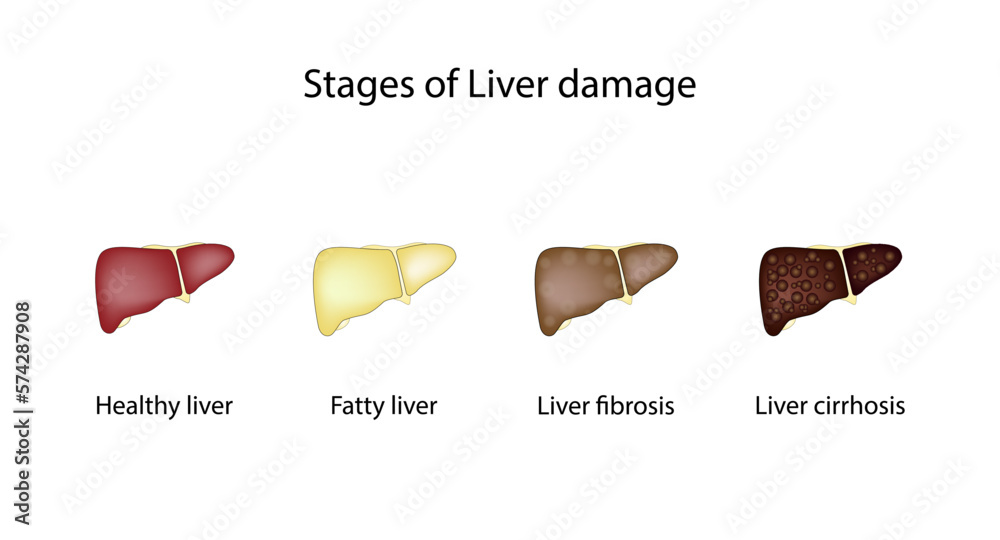 Stages of liver damage, hepatic disease. Liver injury steps from