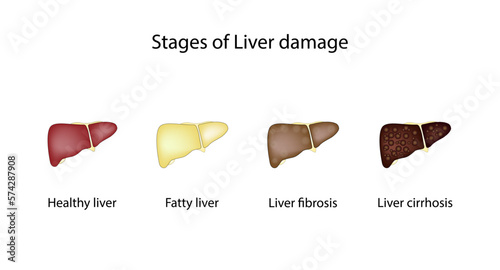 Stages of liver damage, hepatic disease. Liver injury steps from Healthy to fatty liver steatosis, fibrosis and cirrhosis of liver. Vector illustration isolated on white background.  