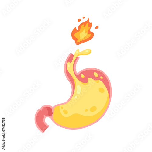 Gastroesophageal reflux disease. Sphincter open allowing acid reflux to esophagus cause of Heartburn. GERD stomach isolated on white background. Health care and medicine illustration flat vector style