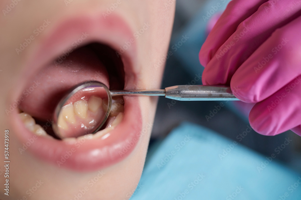 Fotka „A closeup of a young girl getting a dental exam by dentist and