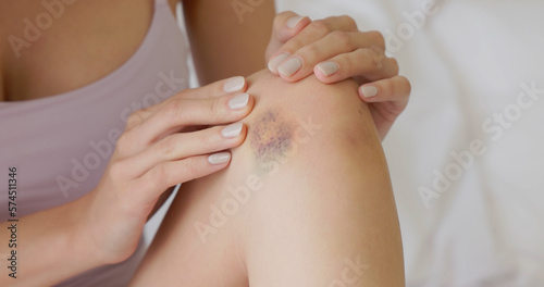 Bruise wound on female leg