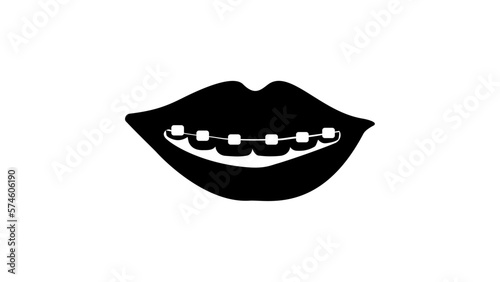 Braces on the teeth