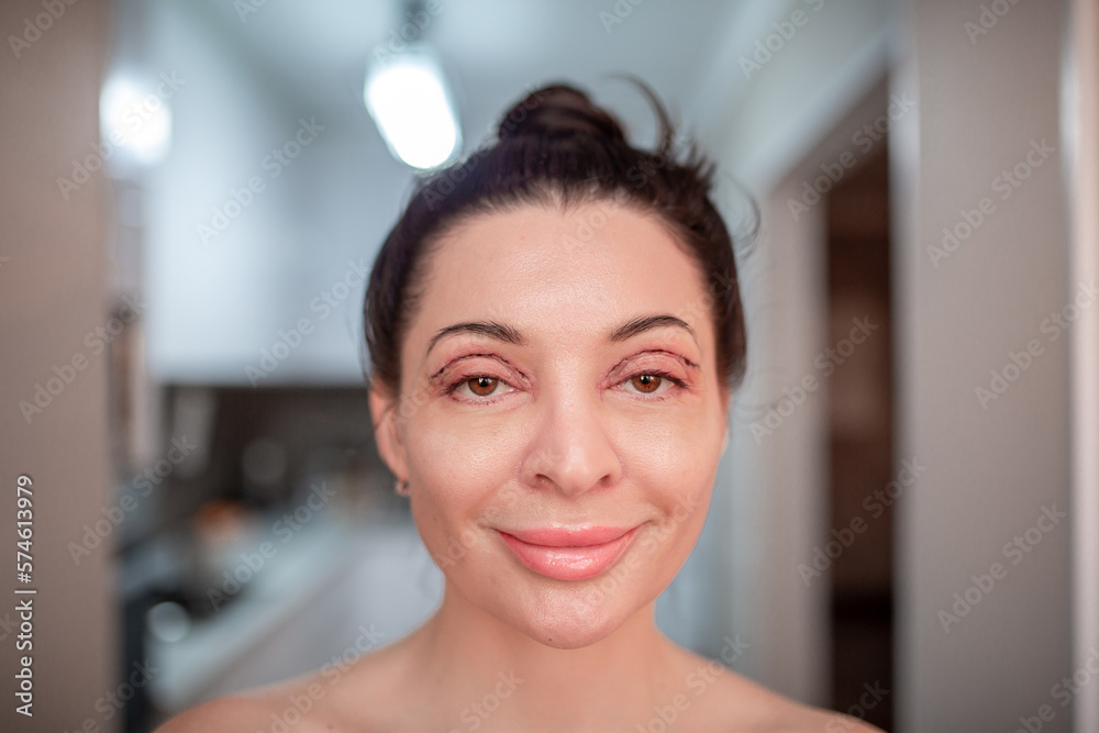 Plastic surgery of the face, skin tightening around the eyes. Surgical procedure to strengthen the skin of the eyelids, remove fatty hernias in the eyes. Operational blepharoplasty. Plastic surgery of the face, skin tightening around the eyes. Surgical procedure to strengthen the skin of the eyelids, remove fatty hernias in the eyes. Operational blepharoplasty.
