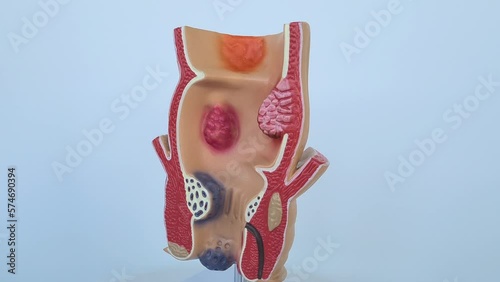 Anatomical model of rectum with hemorrhoids. Hemorrhoids disease associated with thrombosis and inflammation photo