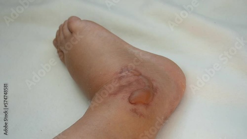 Swollen leg with blisters filled with fluid after frostbite close-up. Swollen foot with fluid-filled blisters from frostbite. Skin swollen in lumps. Foot with bloated. Disease sickness corn callus photo