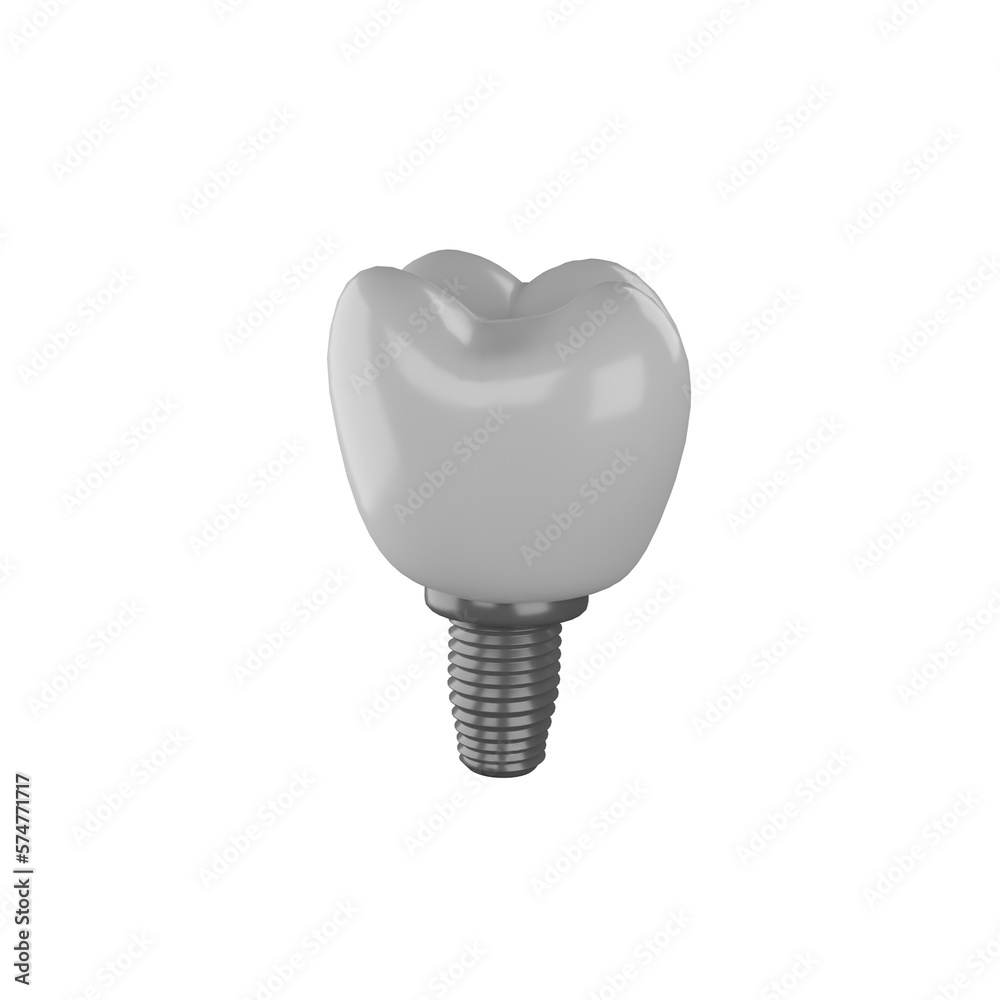 dental teeth implant dental teeth implant