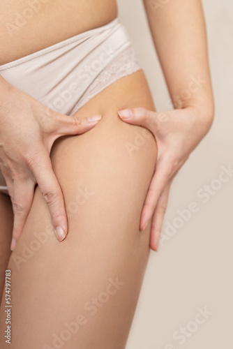 Stretch marks on female legs. A woman's hand holds a fat cellulite and a stretch mark on her leg. Cellulite.