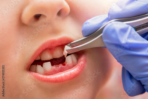 Removal of a milk tooth. The doctor pulled out a tooth from a child with tweezers. Extraction of a child's tooth with a dental instrument. photo