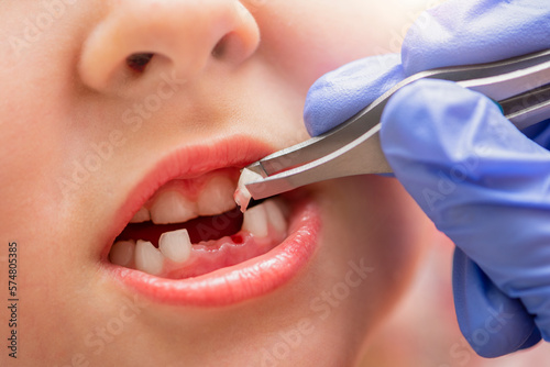 Removal of a milk tooth. The doctor pulled out a tooth from a child with tweezers. Extraction of a child's tooth with a dental instrument.
