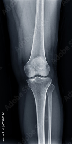 Film x-ray  of Left knee joint  AP view  for diagnosis knee pain from osteoarthritis knee  and fracture .