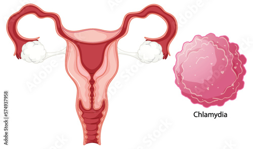 Vaginal infection bacteria concept