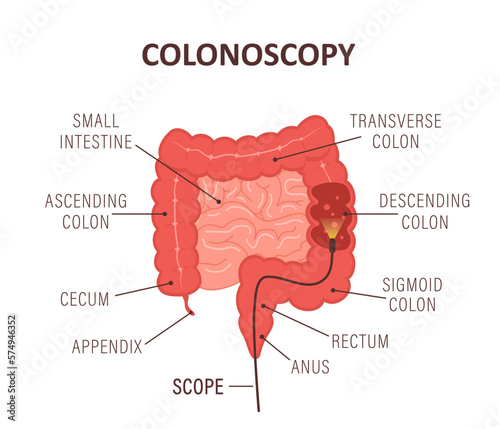 Colonoscopy concept. Intestine exam and treatment. Bowel polypectomy procedure. Anatomy of colon. Prevention of cancer. Vector illustration in flat cartoon style.