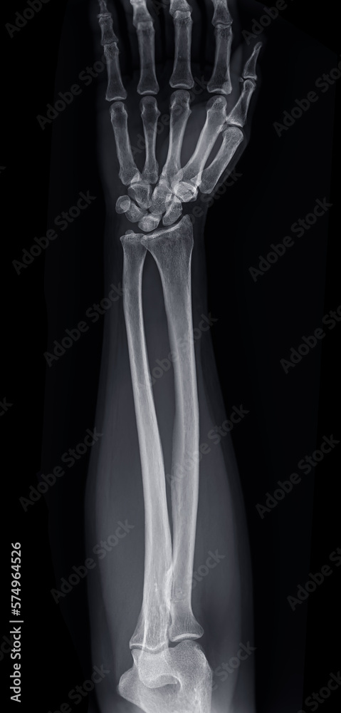 X-ray image of forearm bone. X-ray image of forearm bone.