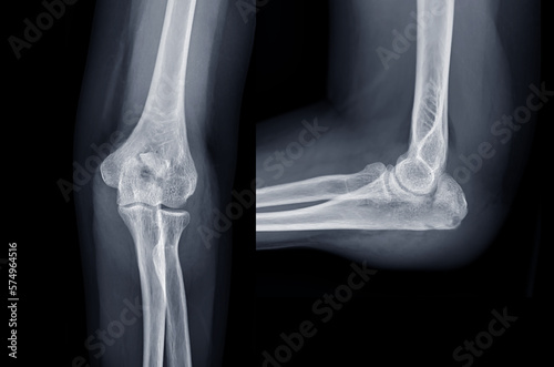 X-ray of Elbow join showing  fracture of ulna bone. photo