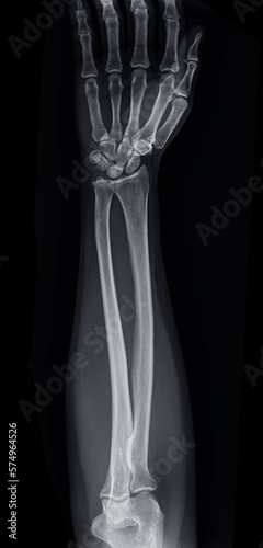X-ray image of forearm bone.