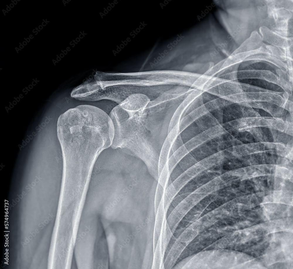 X-ray Shoulder joint shoulder front view for diagnosis fracture of ...