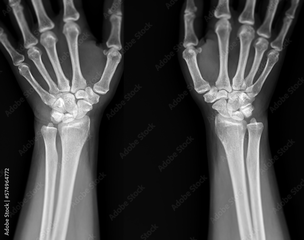 X-ray image of wrist joint front view of normal wrist joint. X-ray image of wrist joint front view of normal wrist joint.