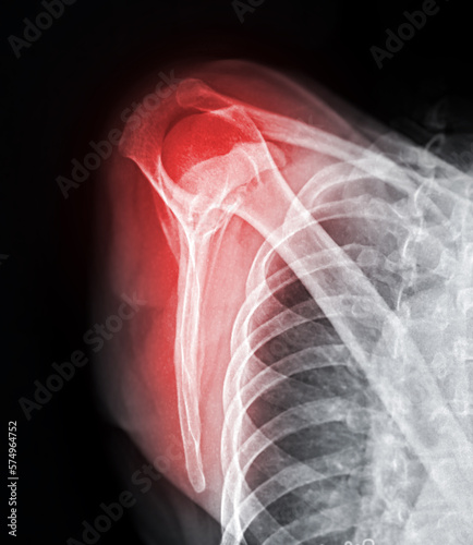 X-ray Shoulder joint shoulder transcapular view for diagnosis fracture of shoulder joint.