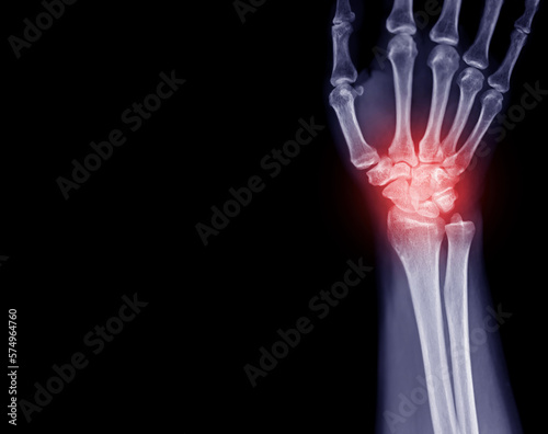 X-ray image of  wrist joint front view of normal wrist joint. photo
