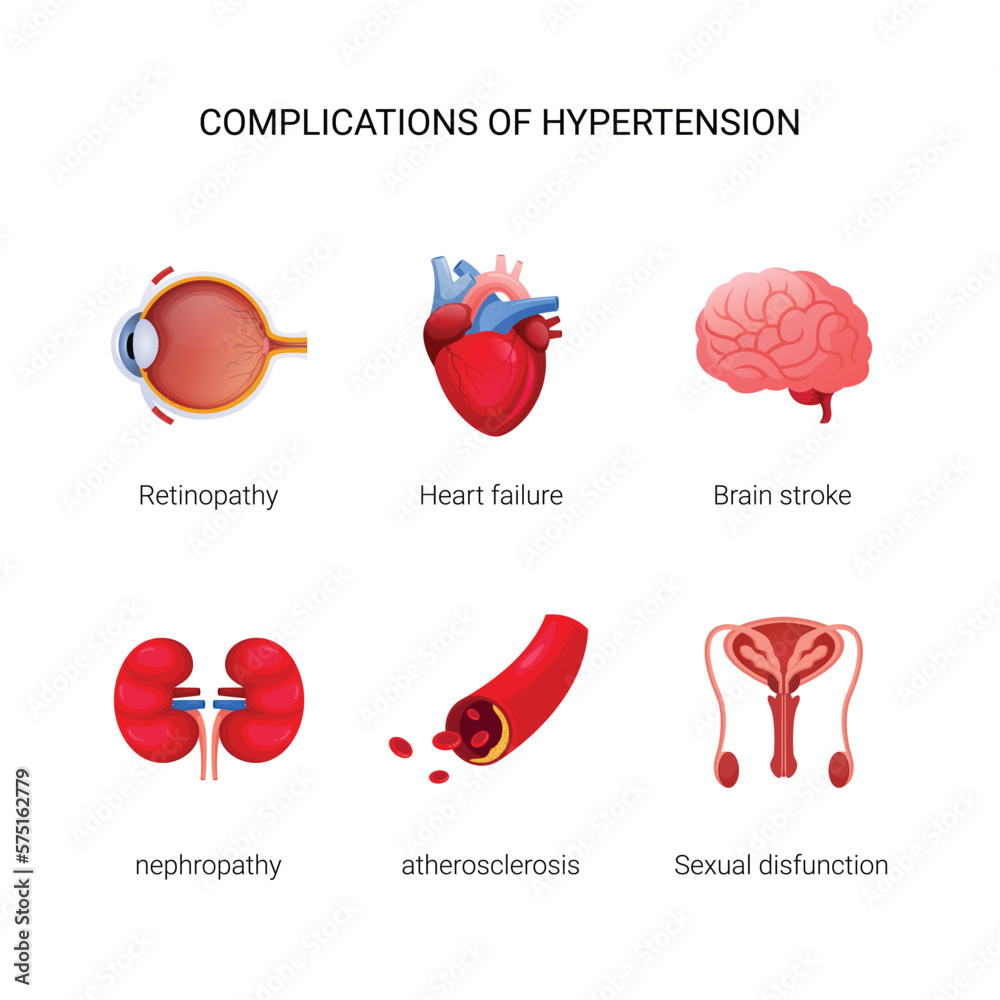 Complications of Hypertension illustration