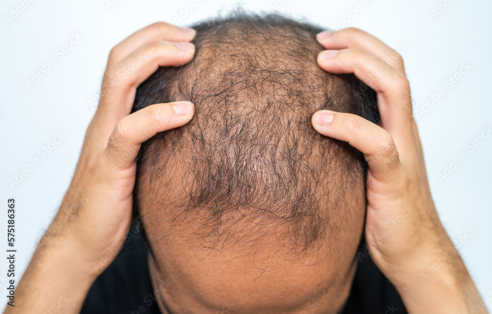 Asian Man Having Stress Cause Of Baldness Problem Baldness Is Related