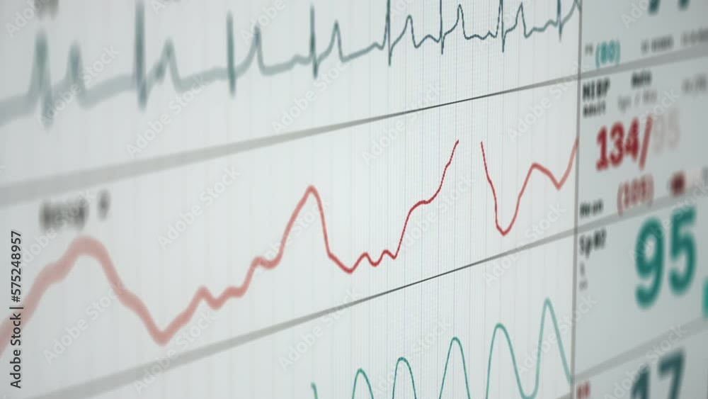 Vidéo Stock Medical monitoring system showing the pulse graph ...